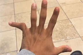 Image result for Deformed Pinky Finger