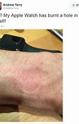 Image result for Apple Watch Skin Burn
