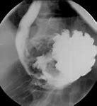Image result for Ileum Carcinoid Tumor