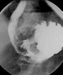 Image result for Carcinoid Tumor