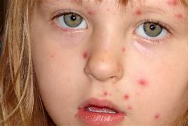 Image result for Chickenpox Disease