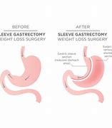 Image result for Gastric Sleeve Bariatric Surgery Procedure