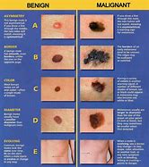 Image result for Dangerous Moles On Your Body