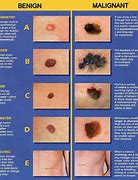 Image result for Raised Skin Cancer Moles