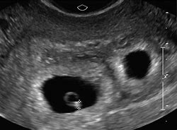 Image result for 6 Weeks 4 Days Pregnant Ultrasound