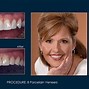 Image result for What Is the Difference Between Ceramic and Porcelain Teeth