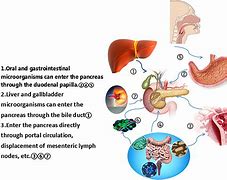 Image result for What Causes Pancreatic Cancer