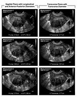 Image result for 8 Cm Fibroid