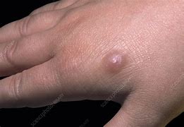 Image result for Molluscum Contagiosum On Finger