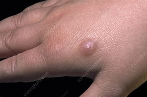 Image result for Molluscum Contagiosum Hands