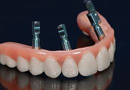 Image result for Zirconium Dental Implants