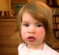 Image result for Fifth Disease and Cough