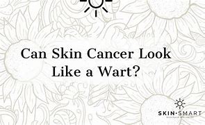 Image result for Wart Like Skin Cancer