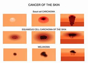 Image result for Beginning Skin Cancer