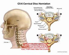 Image result for C5 C6 C7 Vertebrae