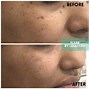 Image result for Mole Removal On Nose