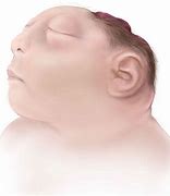 Image result for Anencephaly Anatomy