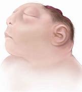 Image result for Anencephaly Pictures