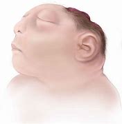 Image result for Anencephaly as Adults