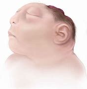 Image result for Anencephaly USG