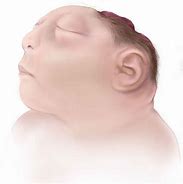 Image result for Infants with Acrania