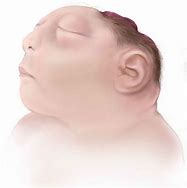 Image result for Anencephaly with Hair
