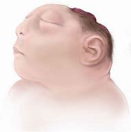 Image result for People with Anencephaly