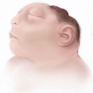 Image result for Fetal Anencephaly Birth