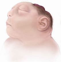 Image result for Anencephaly Scan