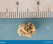 Image result for 6 Millimeter Kidney Stone