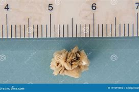Image result for Kidney Stone Size 2Mm