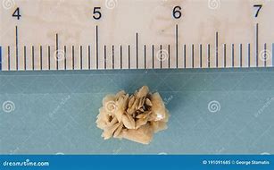 Image result for 2Mm Kidney Stone