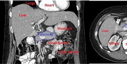 Image result for Pancreas CT Scan