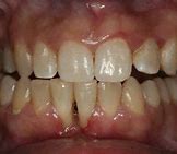 Image result for Thin Gums