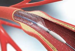 Image result for Carotid Artery Stenting Procedure