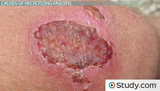 Image result for Flesh-Eating Bacterial Infection