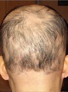Image result for alopedia