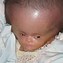 Image result for Hydrocephaly Anencephaly