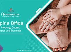 Image result for Open Spina Bifida