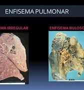 Image result for enfisematoso
