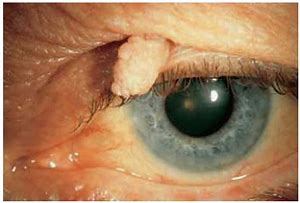 Image result for Papilloma On Upper Eyelid