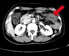 Image result for Colon Cancer Tumor Size