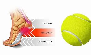 Image result for Plantar Fasciitis Tennis Ball