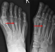 Image result for Stress Fracture Metatarsal Radiology
