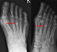 Image result for Fractured Metatarsal