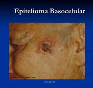 Image result for epitelioma