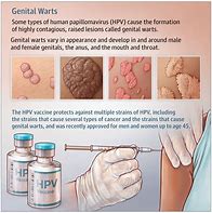 Image result for Female HPV Warts