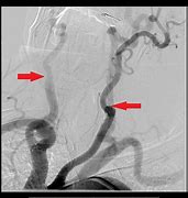 Image result for Carotid Artery Occlusion Stroke