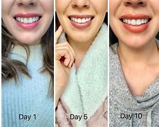 Image result for Crest Whitestrips Professional Before and After