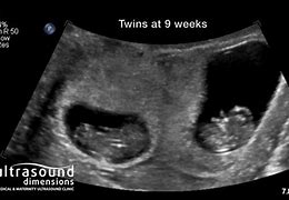 Image result for 42 Weeks Ultrasound Twins